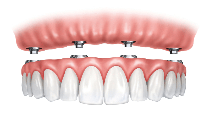 Dental implant Magnolia