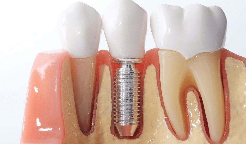 dental implants in Magnolia
